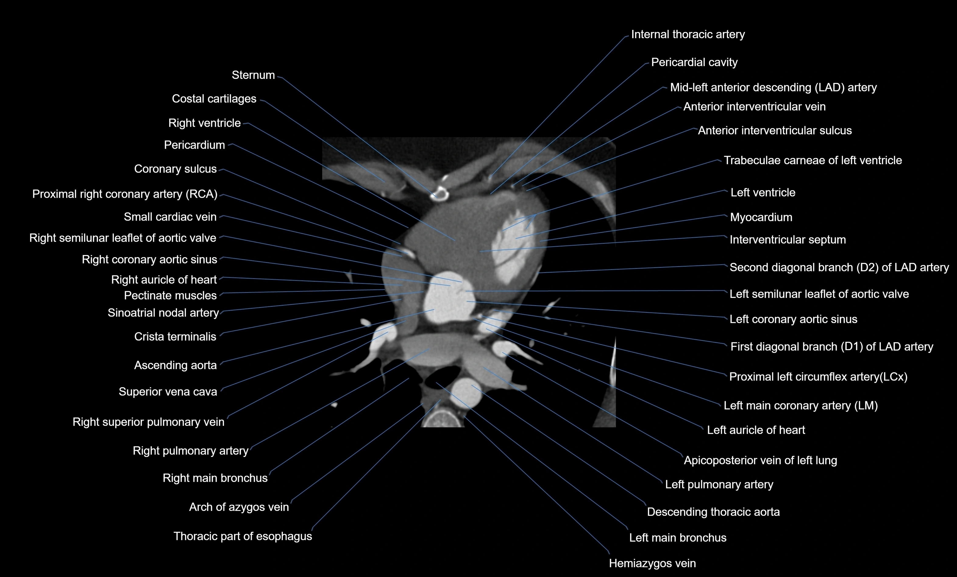 CT heart (coronary angiogram) four chamber view  cross sectional anatomy labelled radiology image -00021.webp